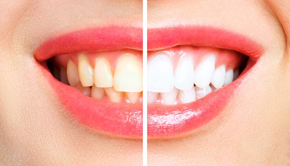 ventajas del blanqueamiento dental