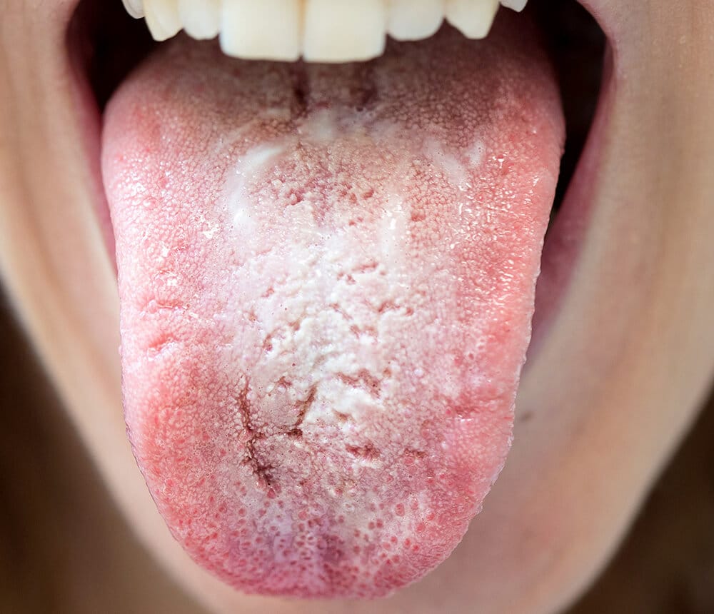manchas blancas en la lengua candidiasis