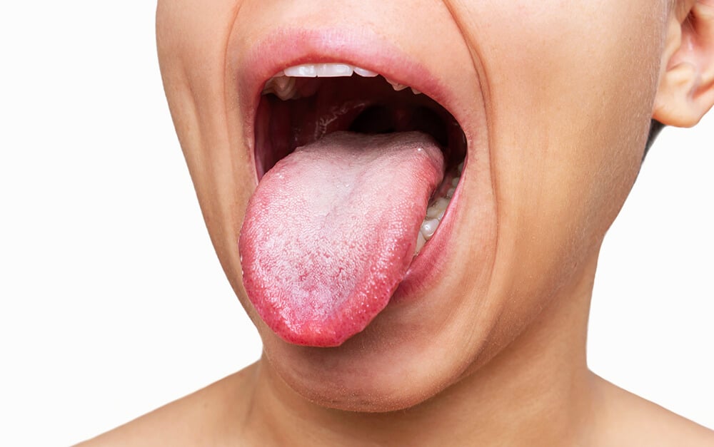 Cómo Limpiar La Lengua Correctamente Clínica Bastida