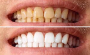eliminar las manchas en los dientes