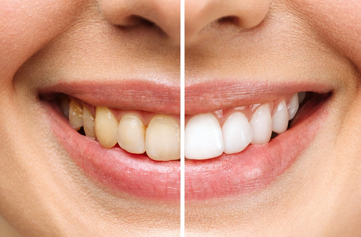 cómo eliminar las manchas en los dientes