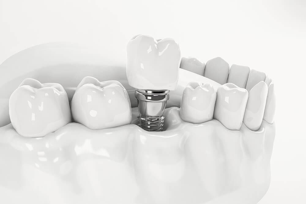 tipos de implantes dentales endoóseos ventajas