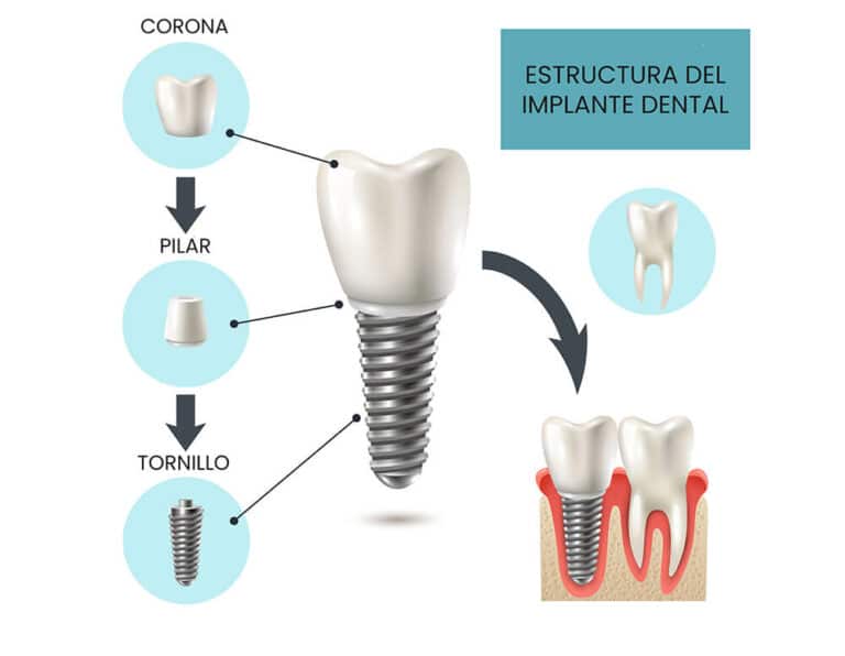 Tipos de implantes dentales y cómo cuidarlos | BASTIDA