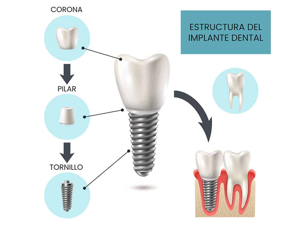 tipos de implantes dentales partes del implante