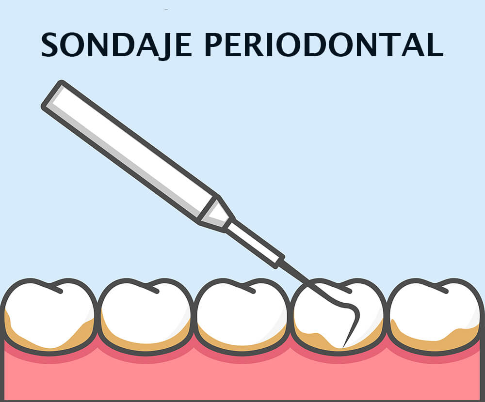 sondaje periodontal infografía