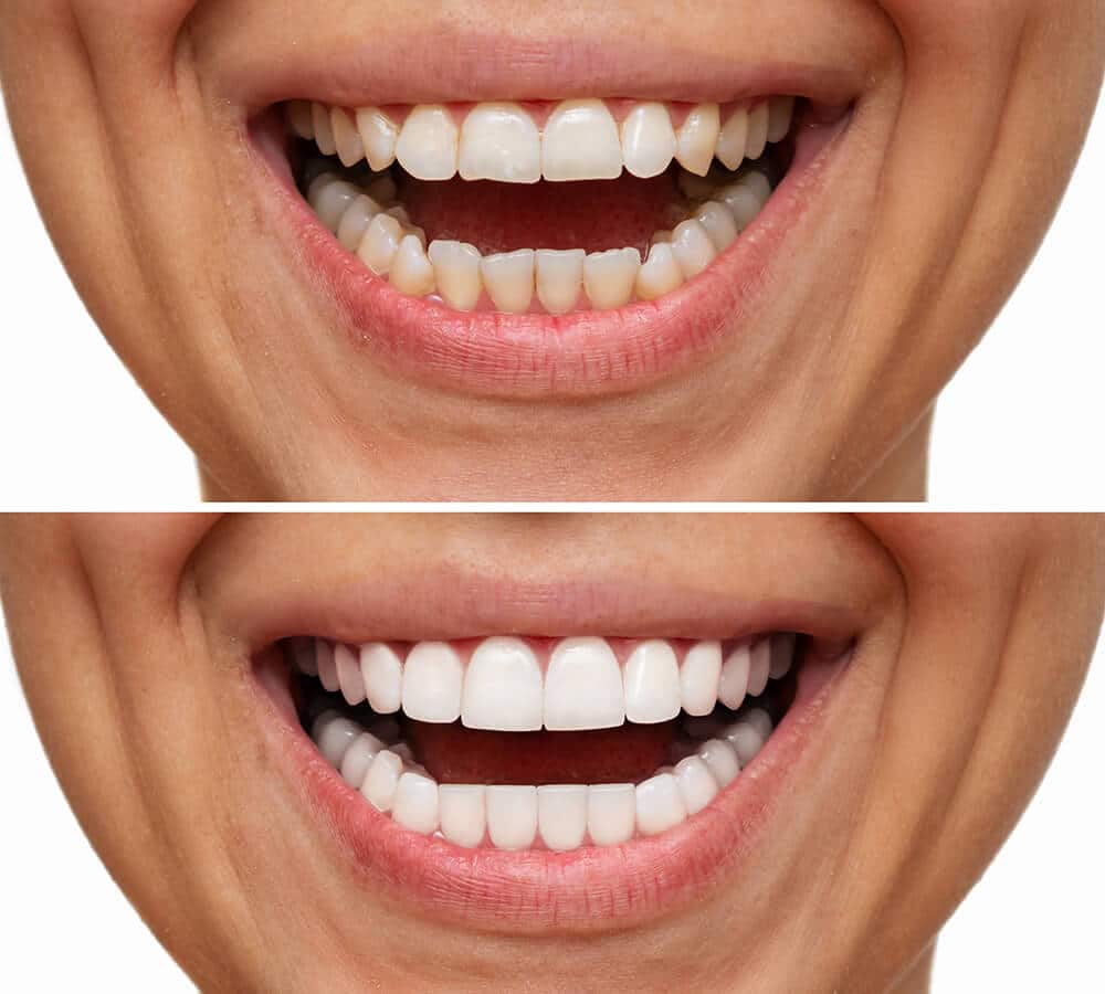 carillas dentales antes y después de colocarlas
