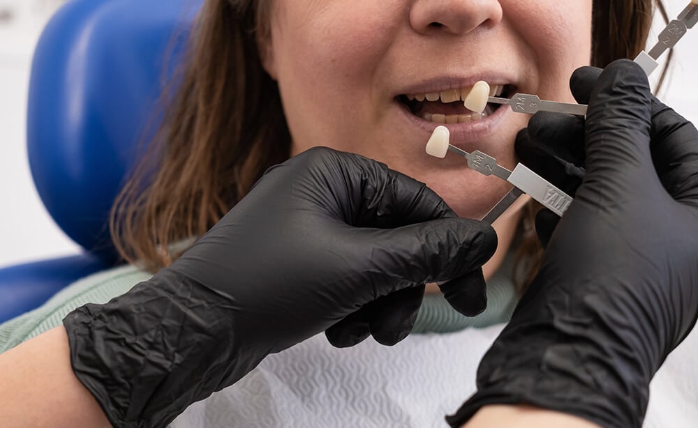cuánto duran las carillas dentales cuidados necesarios