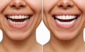 ventajas y desventajas de las carillas dentales