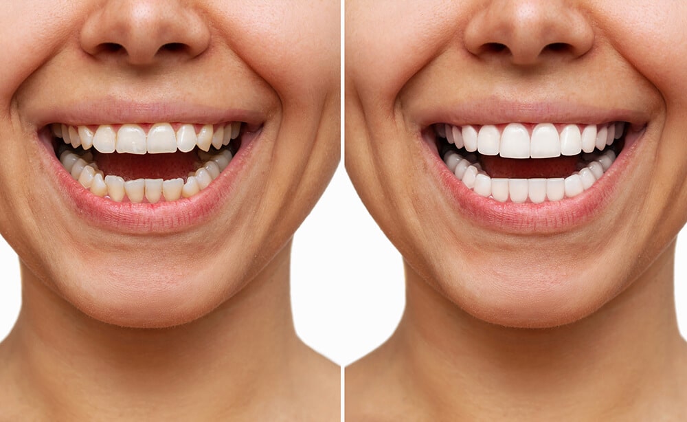 ventajas y desventajas de las carillas dentales