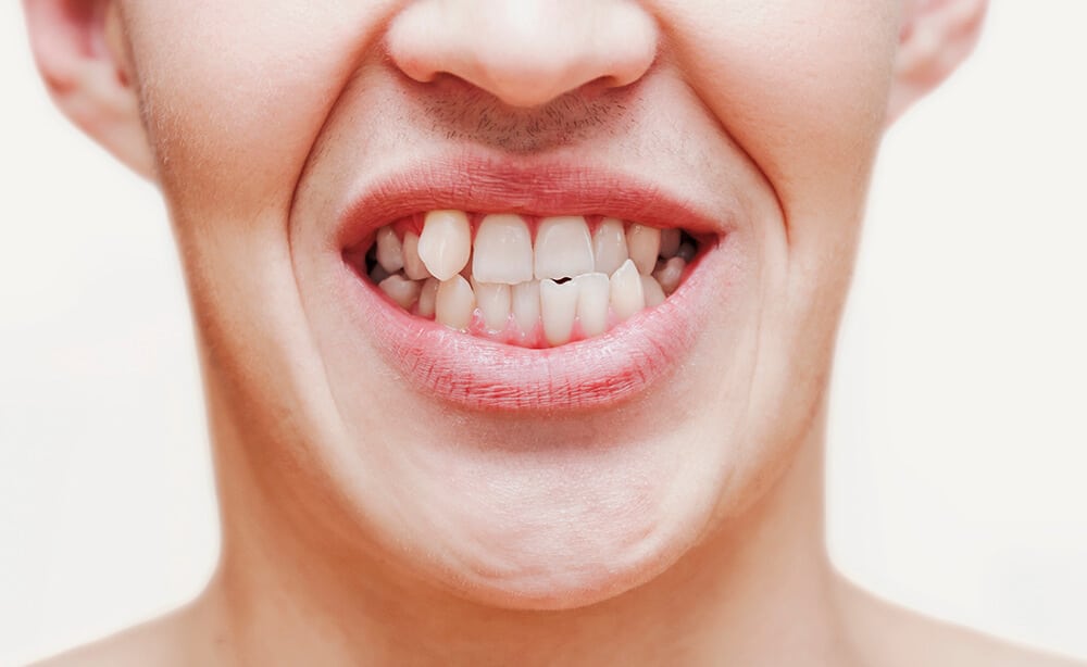 dientes torcidos causas y consecuencias
