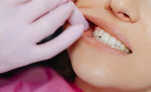 Profilaxis dental