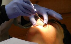 Stripping dental en Ortodoncia