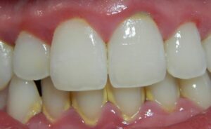 Gingivitis información enfermedad encías
